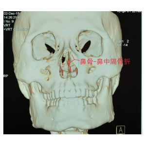 貴陽銘仁耳鼻喉醫(yī)院提醒您：鼻子很脆弱，要好好保護(hù)