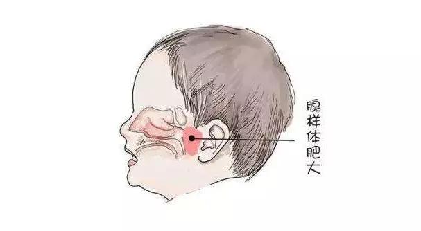 銘仁耳鼻喉專家分享：兒童腺樣體肥大怎么治療比較好？(圖1)