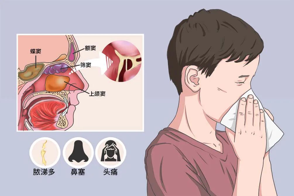 銘仁專家分享：治療鼻竇炎的三個關鍵方法(圖1)