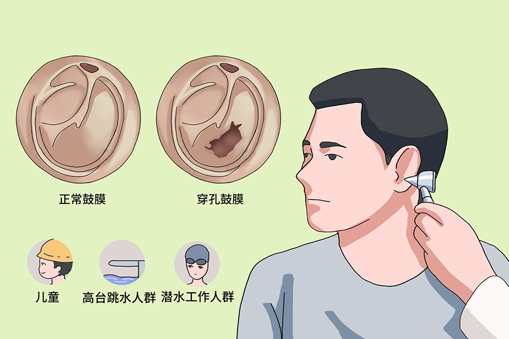 鼓膜穿孔不及時治療，會導致聽力下降，甚至引發(fā)顱內感染？(圖3)