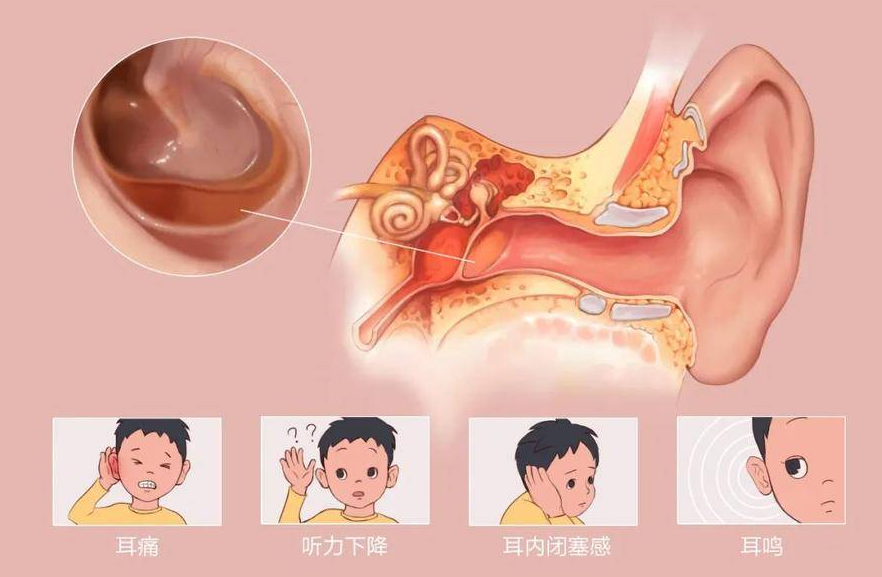 耳朵里耳屎多，到底要不要掏，正確處理方式是？(圖2)