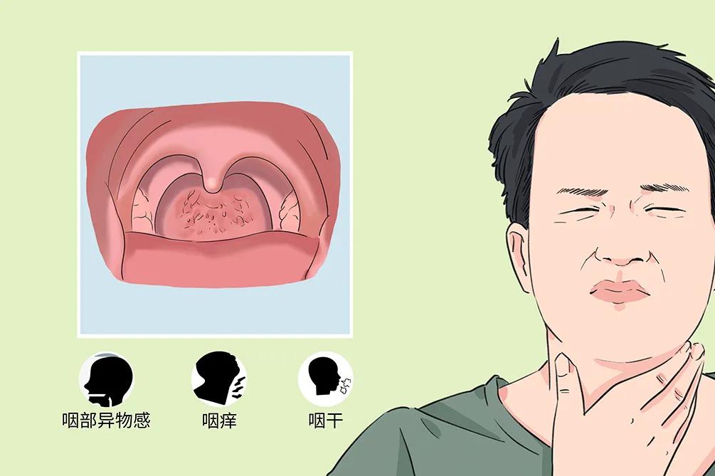 慢性咽炎的困擾：咽干、咽痛、咽部異物感(圖2)