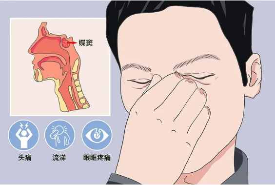 頭疼、眼痛雖小，卻可能是蝶竇炎發(fā)出的警告信號！(圖1)