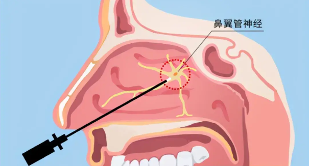 頭疼、眼痛雖小，卻可能是蝶竇炎發(fā)出的警告信號！(圖2)