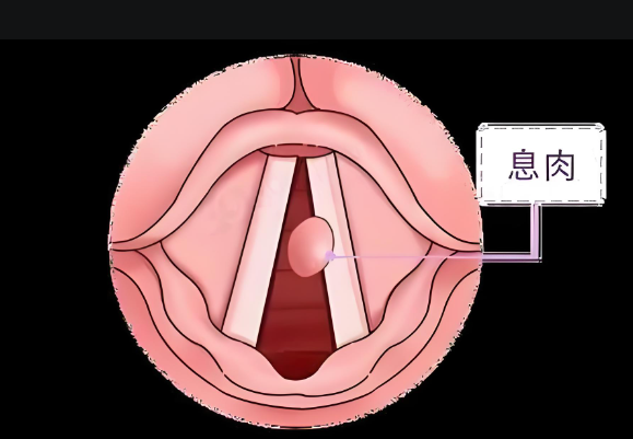 聲音嘶啞、嗓子難受，聲帶息肉不可小覷(圖1)